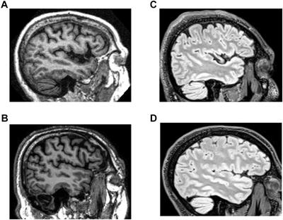 Systematic Differences Between Perceptually Relevant Image Statistics of Brain MRI and Natural Images